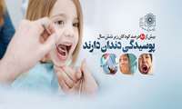 بیش از ۸۰ درصد کودکان زیر شش سال پوسیدگی دندان دارند